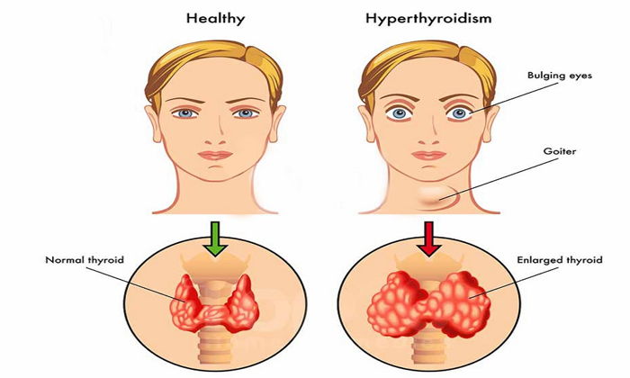 Hipertiroidi - Hipertiroidi