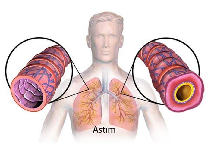 Astım Bronşit - ASTIM - DoktorTakvimi.com